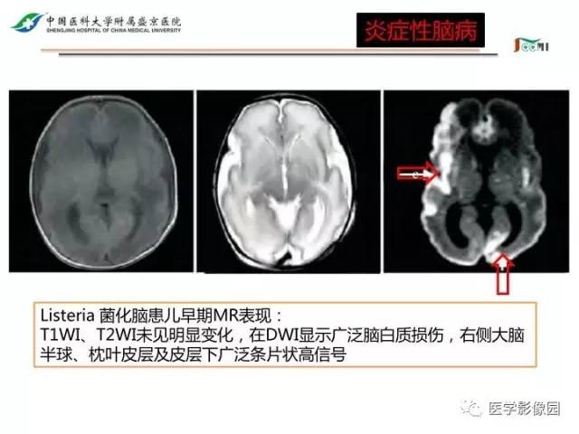 【PPT】常见新生儿脑损伤的MRI检查序列的选择与诊断要点