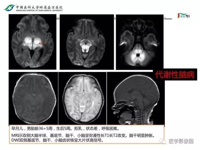 【PPT】常见新生儿脑损伤的MRI检查序列的选择与诊断要点