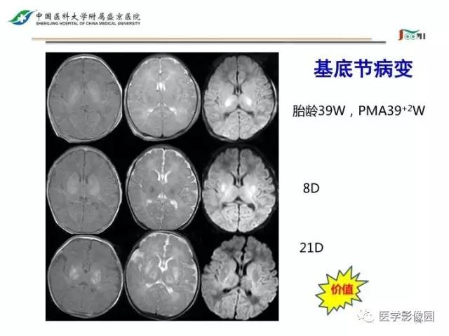 【PPT】常见新生儿脑损伤的MRI检查序列的选择与诊断要点