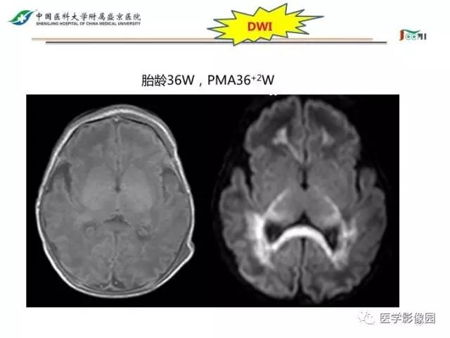 【PPT】常见新生儿脑损伤的MRI检查序列的选择与诊断要点