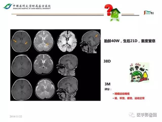 【PPT】常见新生儿脑损伤的MRI检查序列的选择与诊断要点