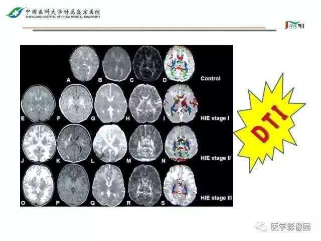 【PPT】常见新生儿脑损伤的MRI检查序列的选择与诊断要点