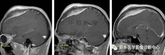 15种脑膜瘤，您见过几种？