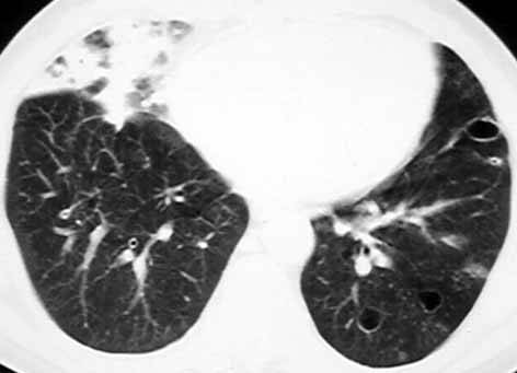 【病例】肺鳞癌肺内转移1例X线CT 【病例】肺鳞癌肺内转移1例X线CT