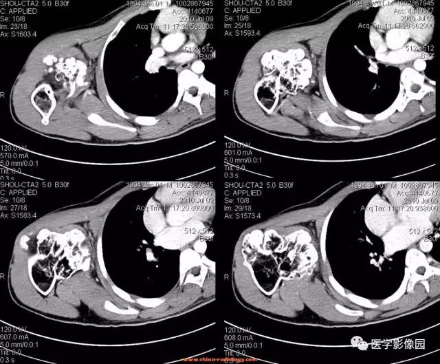 【病例】右肱骨上段骨软骨瘤1例CT影像表现 【病例】右肱骨上段骨软骨瘤1例CT影像表现