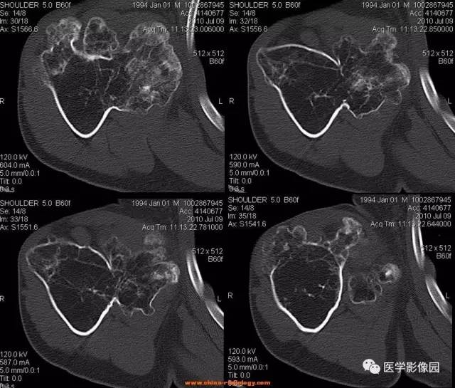 【病例】右肱骨上段骨软骨瘤1例CT影像表现 【病例】右肱骨上段骨软骨瘤1例CT影像表现