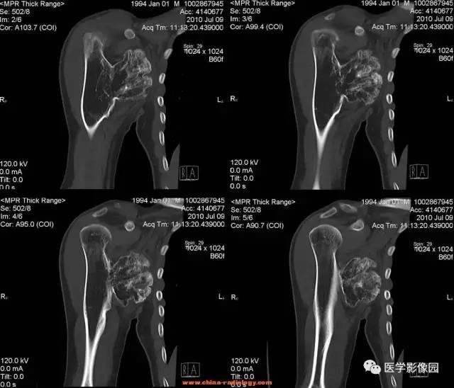 【病例】右肱骨上段骨软骨瘤1例CT影像表现 【病例】右肱骨上段骨软骨瘤1例CT影像表现