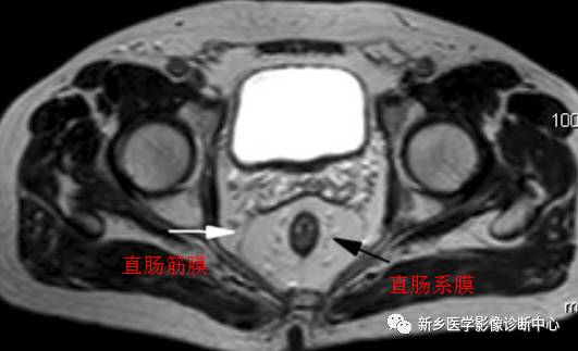 认识这两个解剖结构，在诊断直肠癌中意义更大