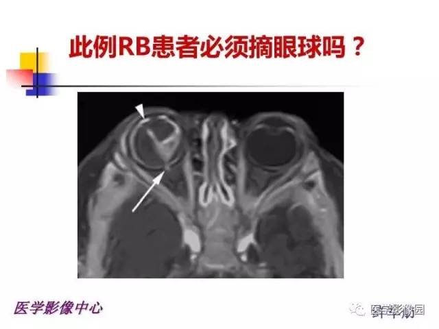 【PPT】儿童RB影像诊断分析思路