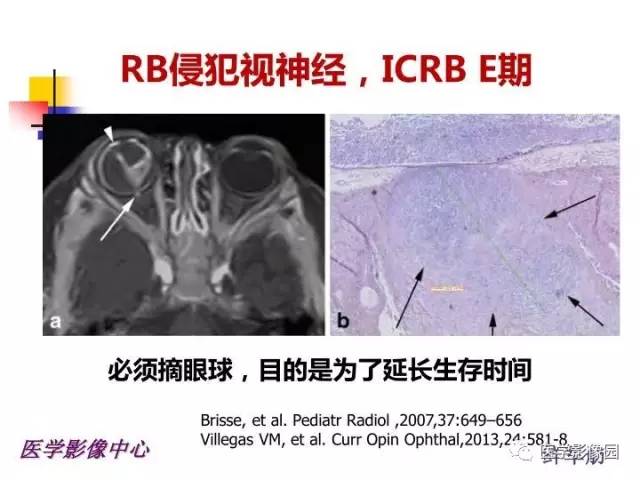 【PPT】儿童RB影像诊断分析思路