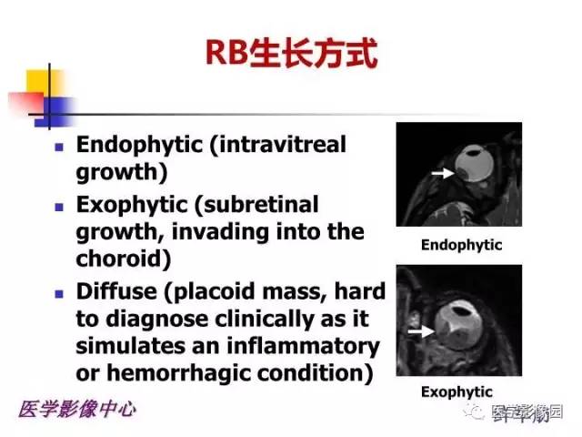 【PPT】儿童RB影像诊断分析思路