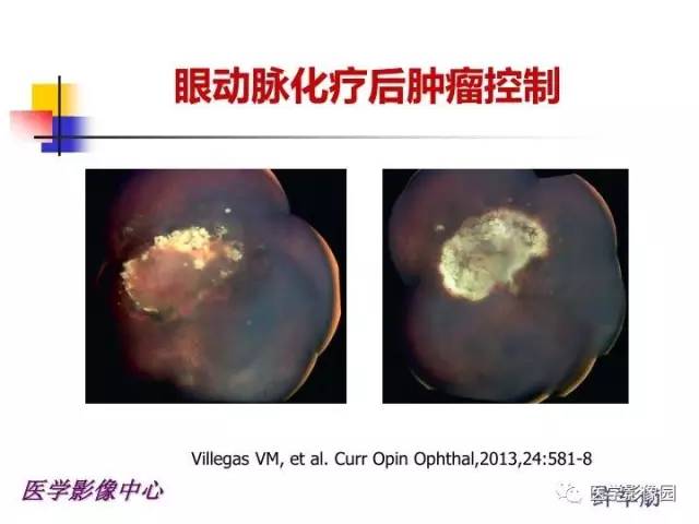 【PPT】儿童RB影像诊断分析思路