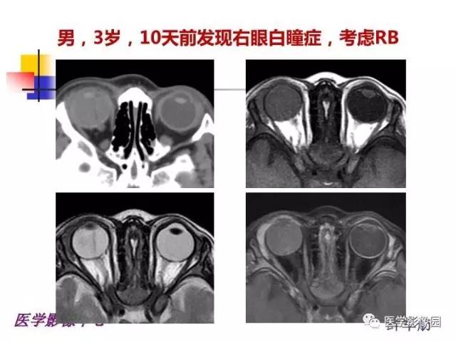 【PPT】儿童RB影像诊断分析思路