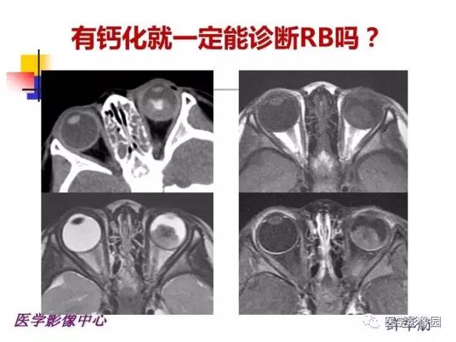 【PPT】儿童RB影像诊断分析思路