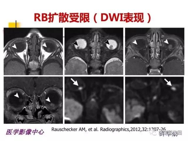 【PPT】儿童RB影像诊断分析思路