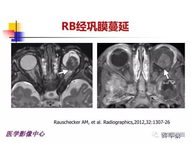 【PPT】儿童RB影像诊断分析思路