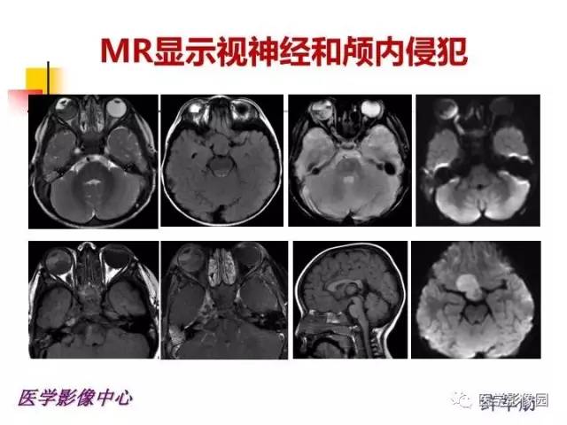 【PPT】儿童RB影像诊断分析思路