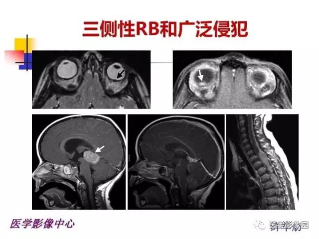 【PPT】儿童RB影像诊断分析思路