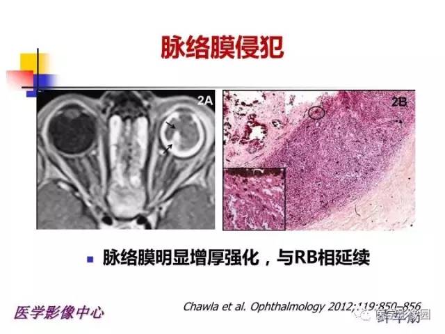 【PPT】儿童RB影像诊断分析思路