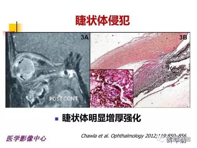 【PPT】儿童RB影像诊断分析思路