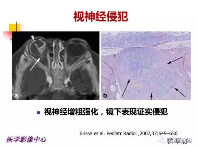 【PPT】儿童RB影像诊断分析思路