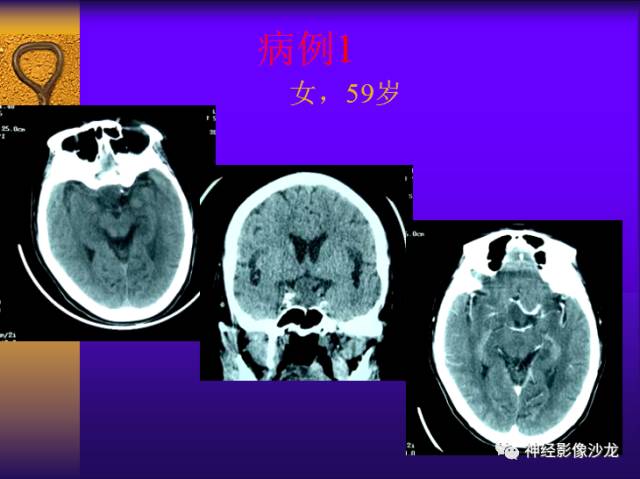 【病例】鞍区病变6例CT及MR