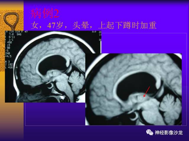 【病例】鞍区病变6例CT及MR