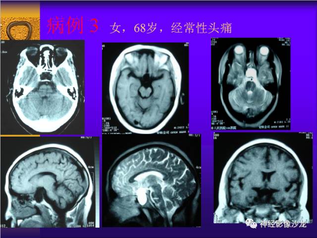 【病例】鞍区病变6例CT及MR