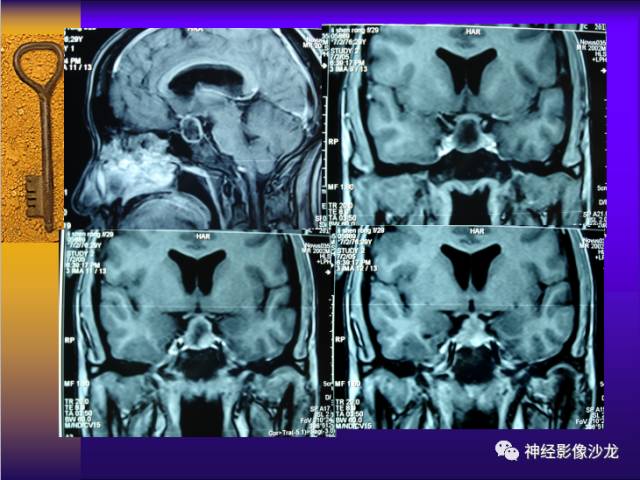 【病例】鞍区病变6例CT及MR