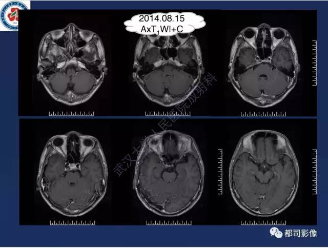 【病例】颅底软骨肉瘤1例CT及MR影像诊断