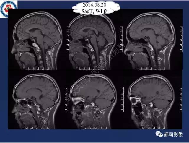 【病例】颅底软骨肉瘤1例CT及MR影像诊断