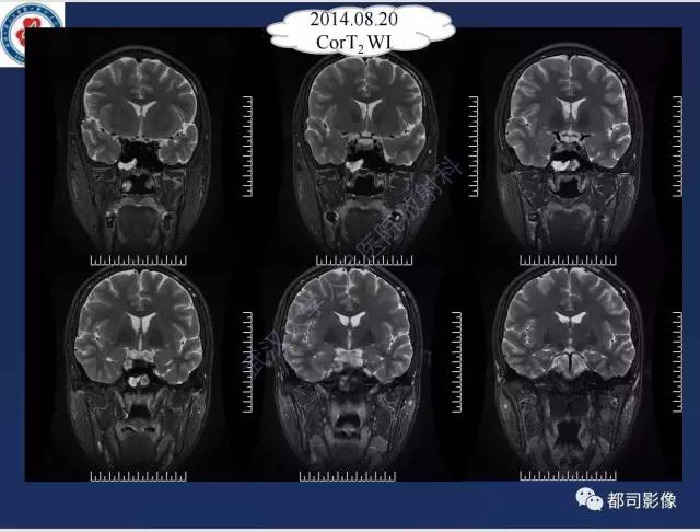 【病例】颅底软骨肉瘤1例CT及MR影像诊断