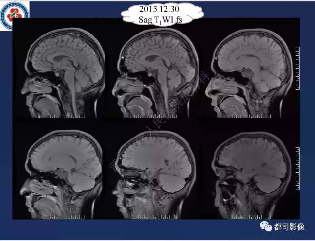 【病例】颅底软骨肉瘤1例CT及MR影像诊断