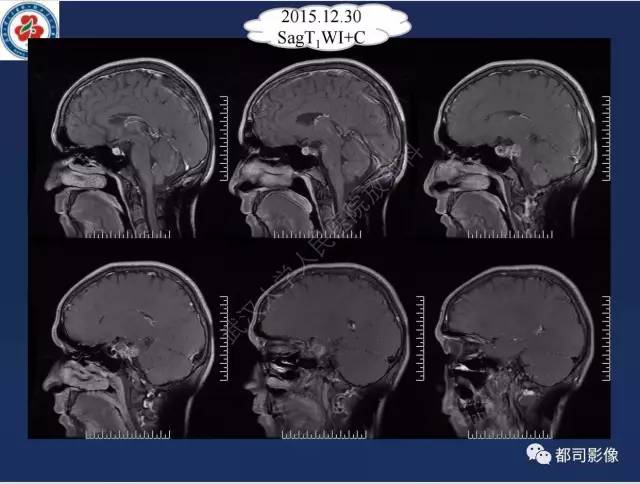 【病例】颅底软骨肉瘤1例CT及MR影像诊断