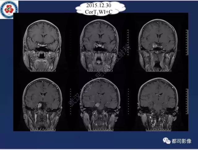 【病例】颅底软骨肉瘤1例CT及MR影像诊断