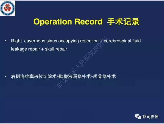 【病例】颅底软骨肉瘤1例CT及MR影像诊断