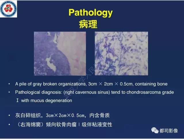 【病例】颅底软骨肉瘤1例CT及MR影像诊断