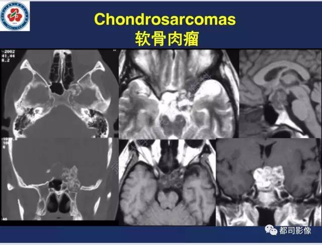 【病例】颅底软骨肉瘤1例CT及MR影像诊断