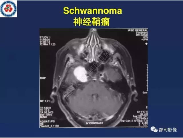 【病例】颅底软骨肉瘤1例CT及MR影像诊断