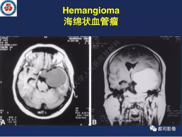 【病例】颅底软骨肉瘤1例CT及MR影像诊断
