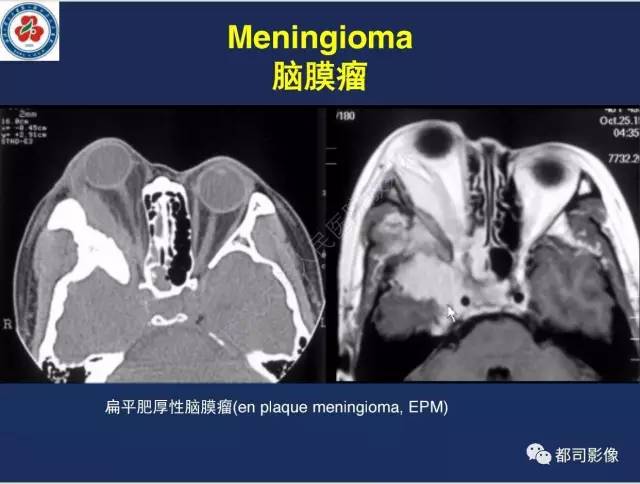 【病例】颅底软骨肉瘤1例CT及MR影像诊断
