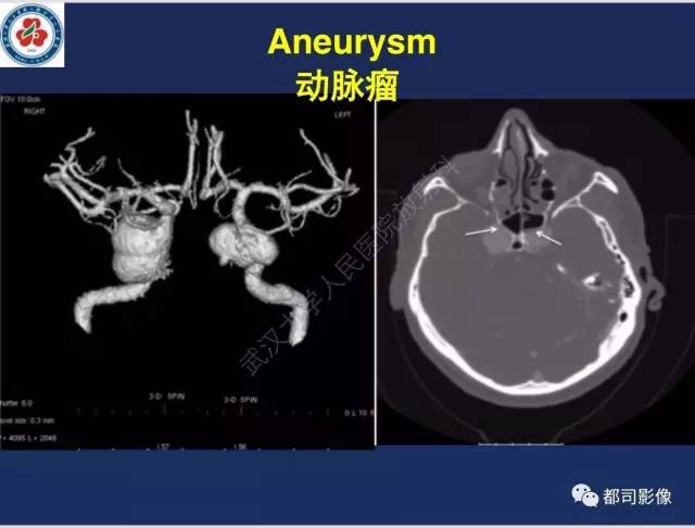 【病例】颅底软骨肉瘤1例CT及MR影像诊断