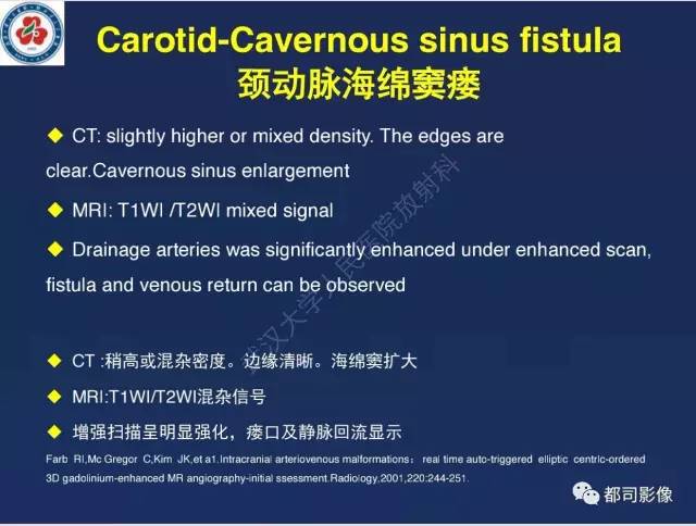 【病例】颅底软骨肉瘤1例CT及MR影像诊断