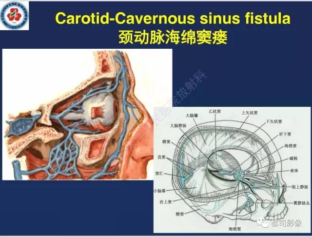 【病例】颅底软骨肉瘤1例CT及MR影像诊断