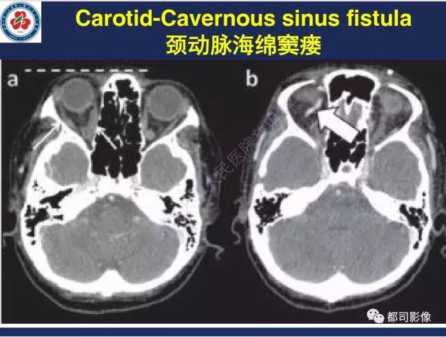 【病例】颅底软骨肉瘤1例CT及MR影像诊断