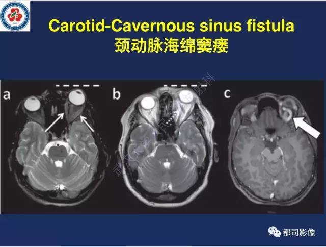 【病例】颅底软骨肉瘤1例CT及MR影像诊断
