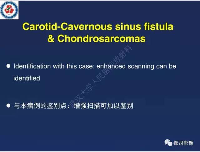 【病例】颅底软骨肉瘤1例CT及MR影像诊断