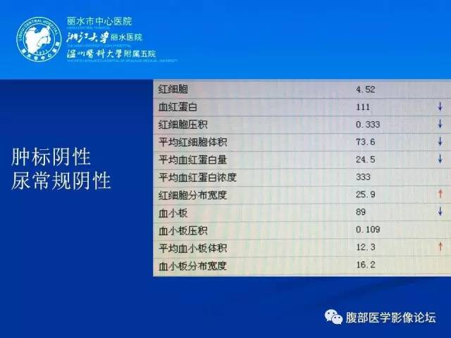 【病例】肾嫌色细胞癌1例CT影像表现 【病例】肾嫌色细胞癌1例CT影像表现