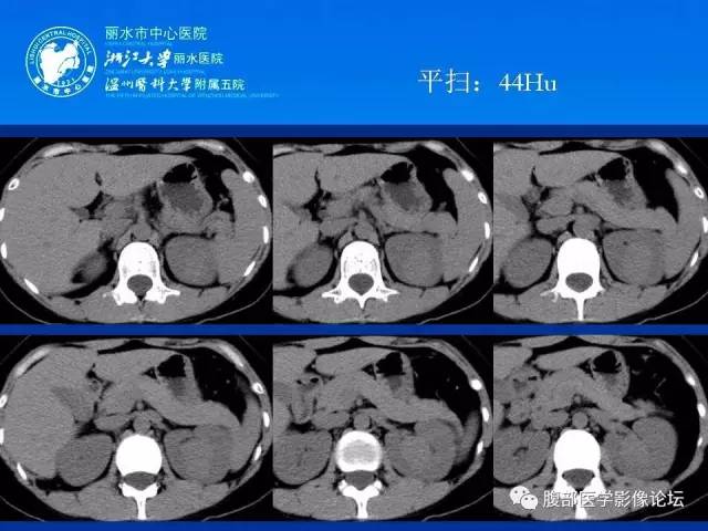 【病例】肾嫌色细胞癌1例CT影像表现 【病例】肾嫌色细胞癌1例CT影像表现