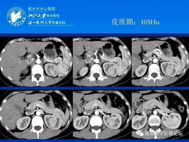 【病例】肾嫌色细胞癌1例CT影像表现 【病例】肾嫌色细胞癌1例CT影像表现